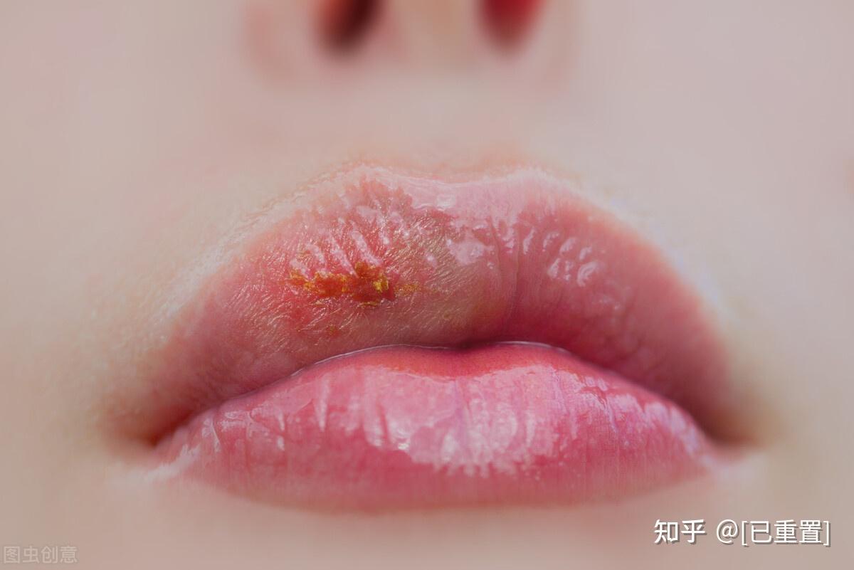 嘴唇上长痘（有图）是什么身体原因引起的？_百度知道