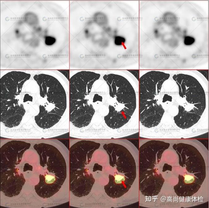 男,77岁,PET/CT诊断食管癌术后左肺上叶鳞癌1例 - 知乎