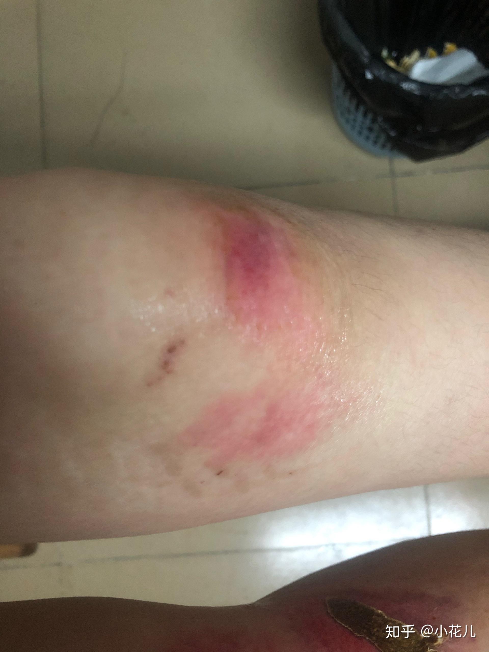 双膝擦伤恢复去疤纪录贴