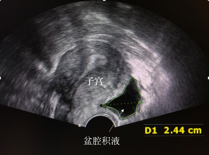 盆腔积液会引起肚子痛吗该怎么办