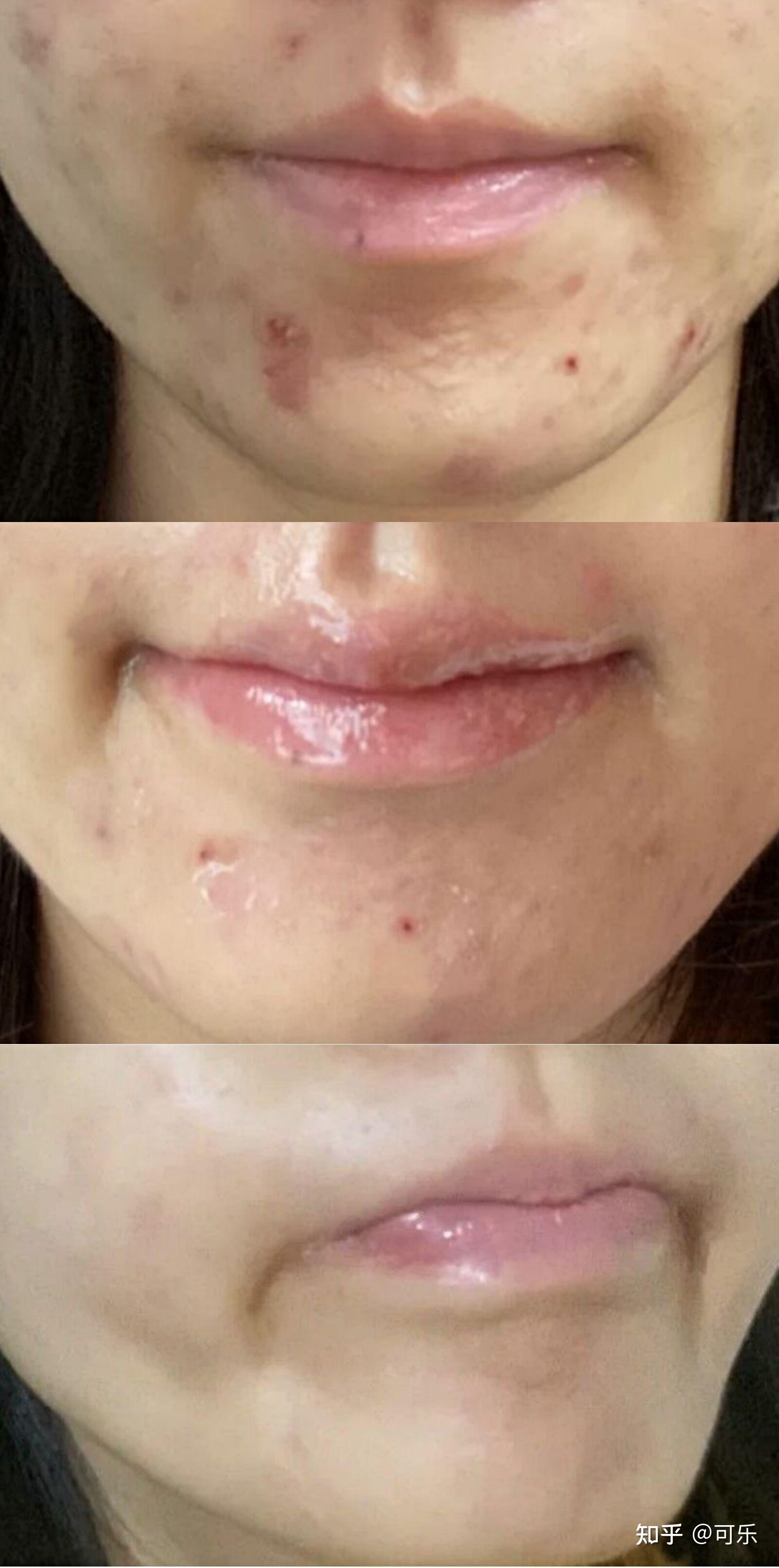 女生在熬夜后如何快速恢复颜值