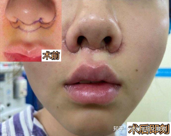 人中缩短除了可以缩短人中还可以改善哪些问题