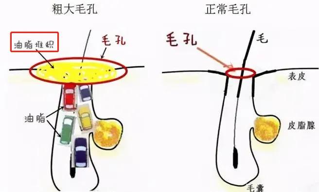 【男生毛孔粗大必看】男士收缩毛孔用什么最好最有效?医学生教你4步,1个月改善男生毛孔粗大、细腻紧致皮肤! - 知乎