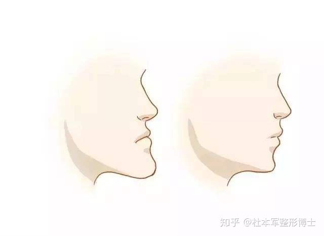 "地包天"不少是因为上下颌骨的生长错位,下颌骨太靠前,而上颌骨太靠后