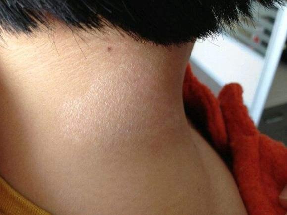 神经性皮炎怎么治中医分型疗法治疗神经性皮炎怎么样