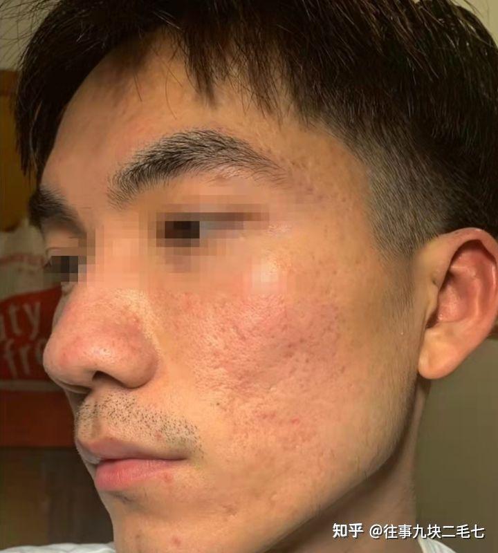 油性皮肤男生如何护肤