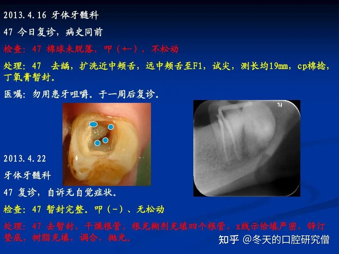 c型根管的特點及解析