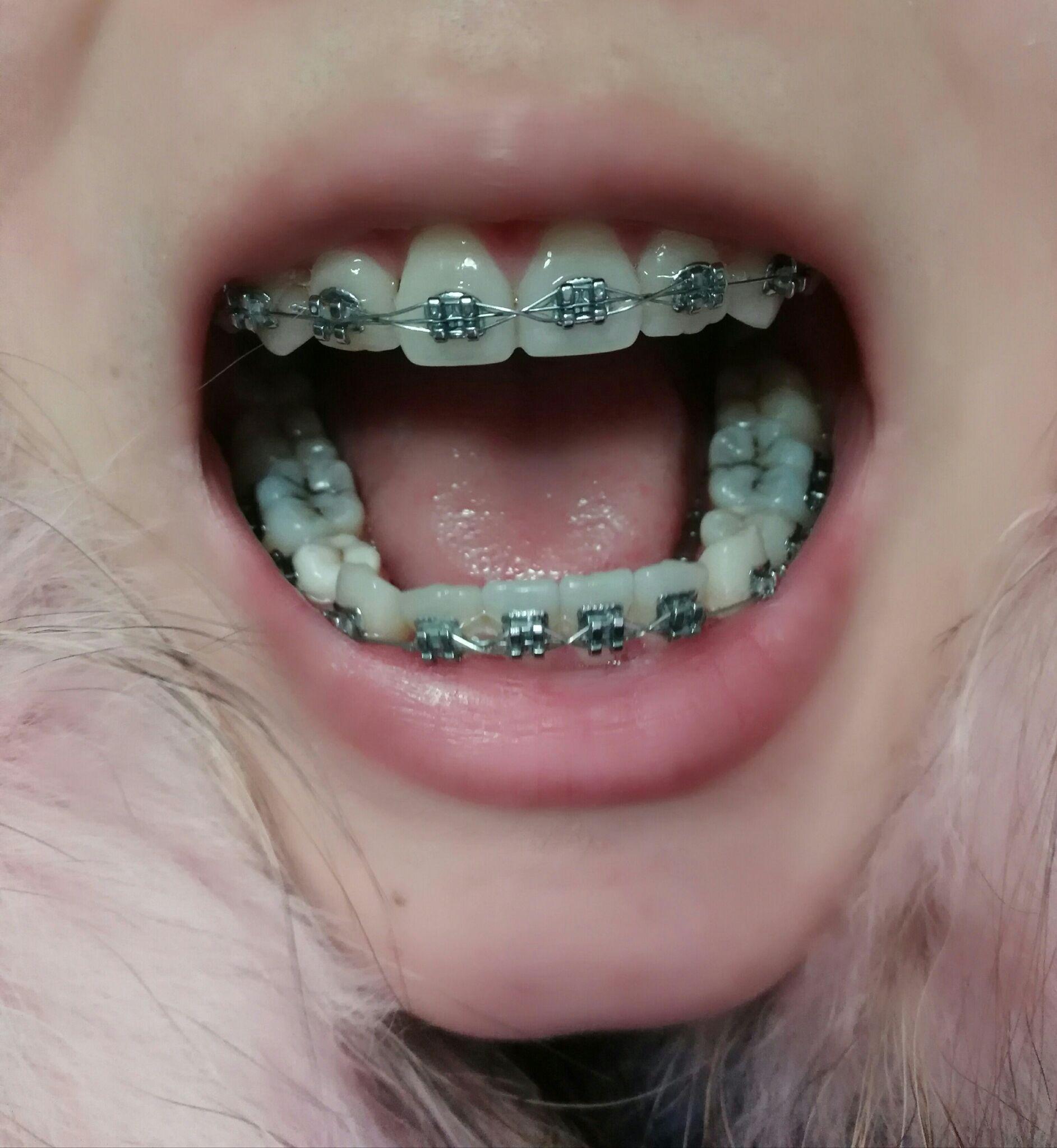 正畸拔四颗4号牙记录不定时更新