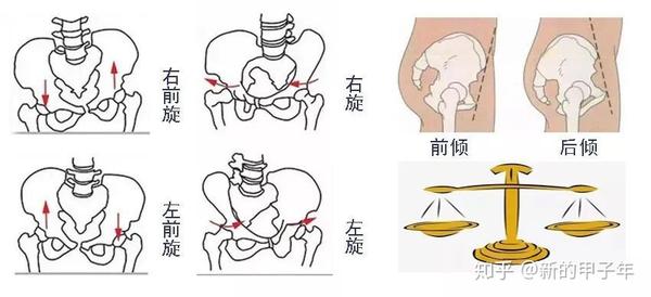 拇外翻除了针对性的康复外,还要调整骨盆,纠正腿部的力线,让足部回到