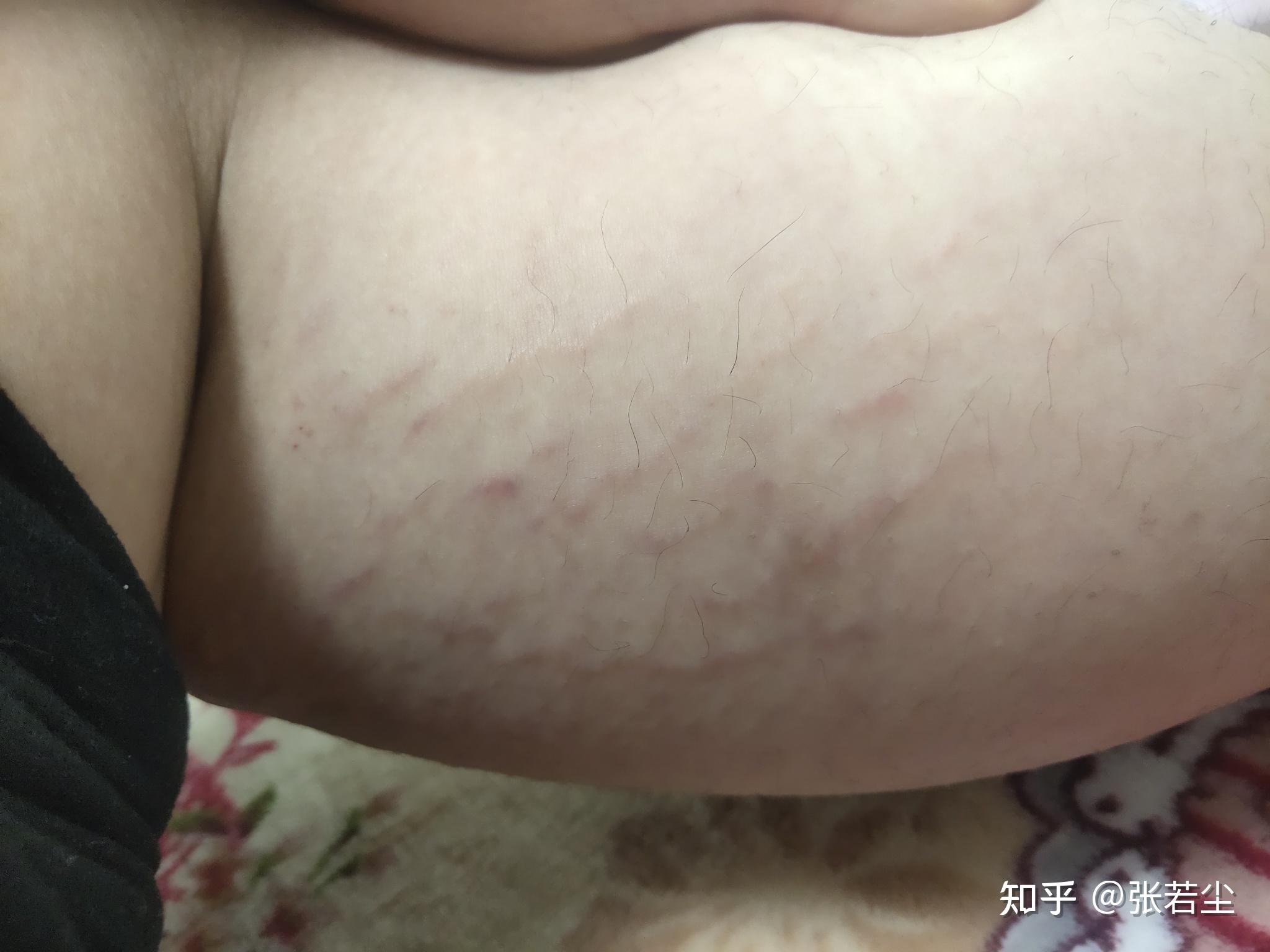 腿上有红血丝 - 知乎