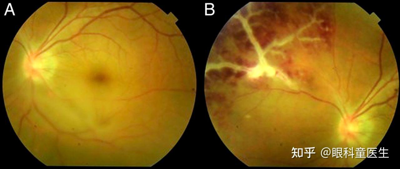 后葡萄膜炎12白塞病