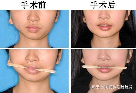 歪脸可以恢复对称吗