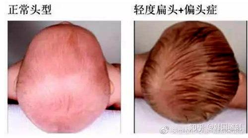 睡扁头与会造成你的脸大这其中有什么关系骨水泥填充