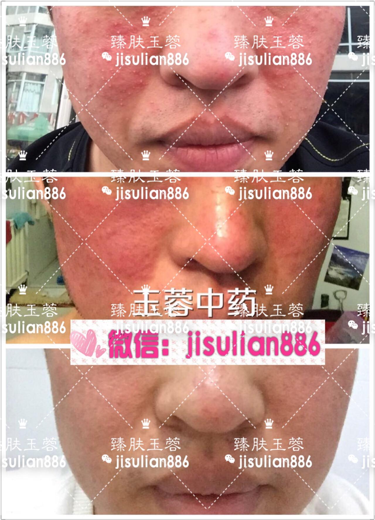激素脸排毒过程照片图片