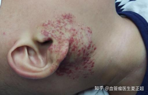 毛细血管瘤的病因_为什么会得毛细血管瘤 - 知乎