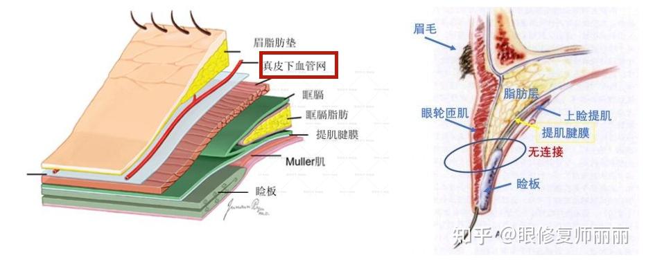 师丽丽眼修复丨双眼皮术后出现肉条的不同原因和修复方法