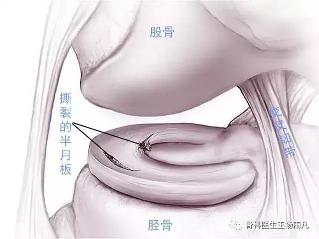 盘状半月板遗传几率图片