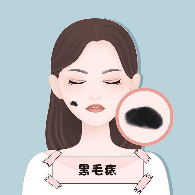 各种胎记和斑痣解析大全建议收藏