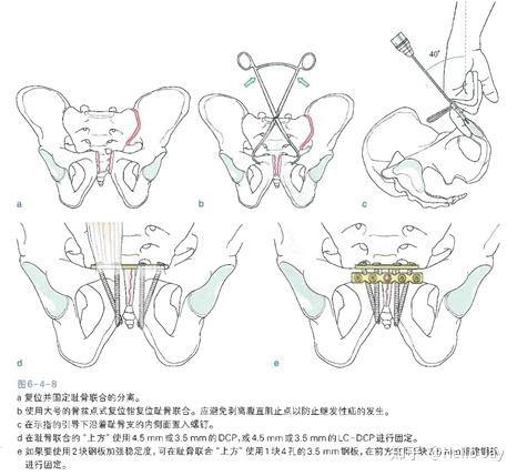 骨盆環損傷的治療原則