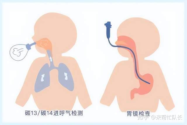认识吹气的正确姿势呼气试验测幽门螺杆菌准确率高达97
