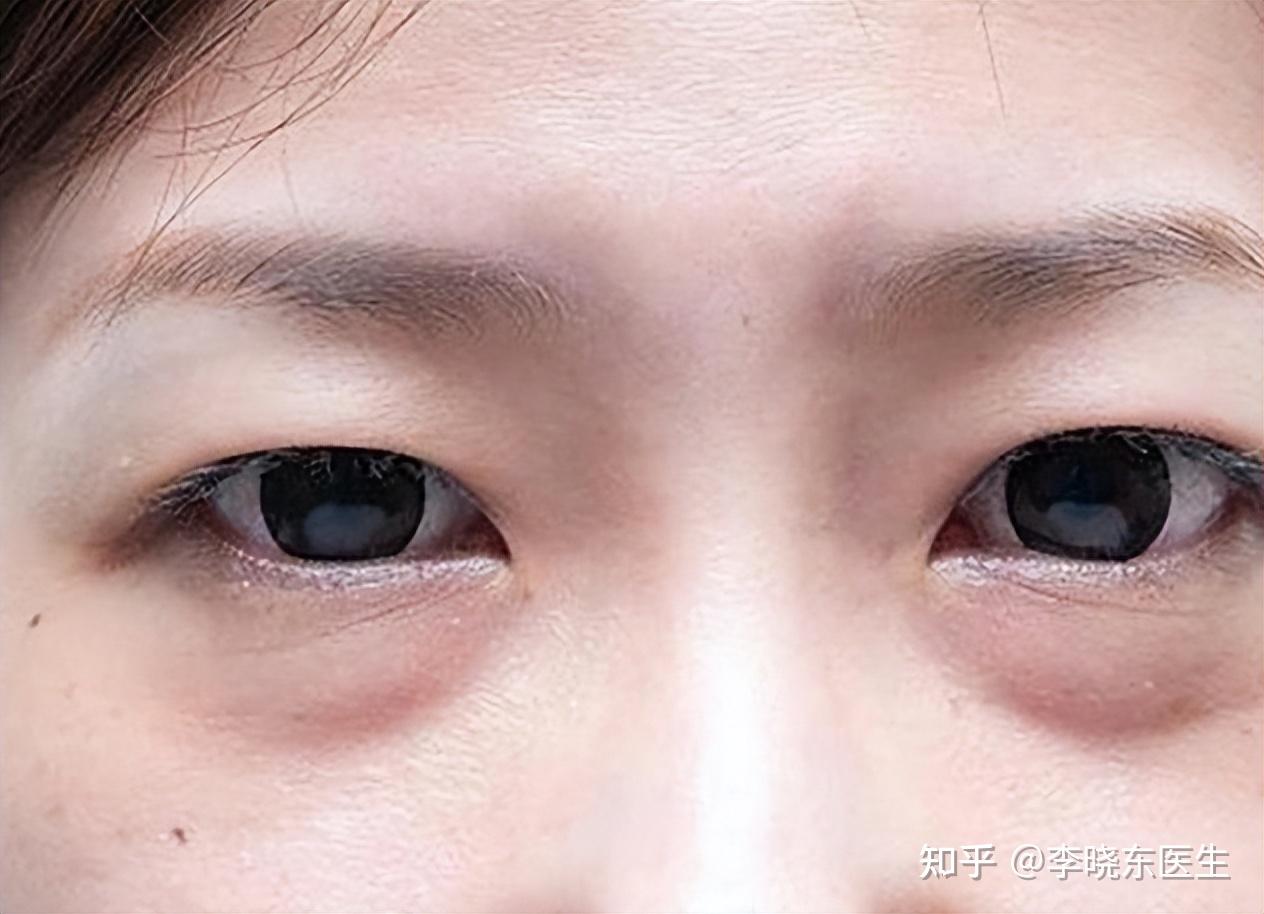 杭州眼窝凹陷脂肪填充+双眼皮开眼角案例 - 知乎