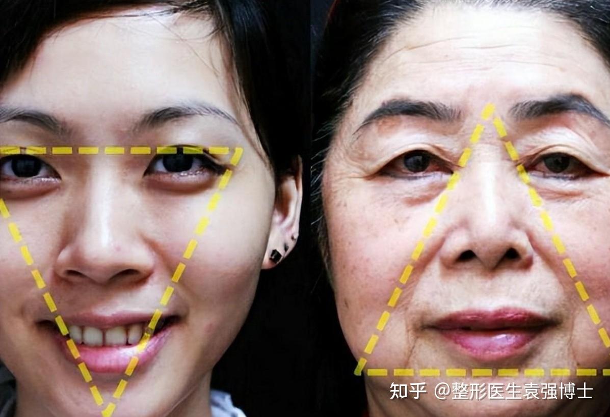 上海仁爱医院V-LINE瓜子脸手术怎么样_恢复过程_效果如何_氧气062na整形日记1.10_新氧美容整形