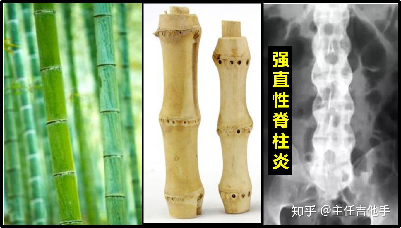 强直性脊柱炎竹节图片
