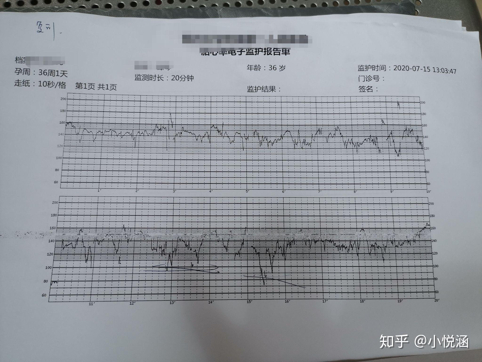 让人抓狂的胎心监护