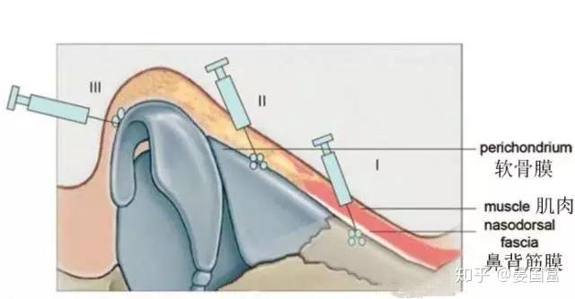 鼻子不通的原理_注射隆鼻:注射隆鼻的原理与手术隆鼻的原理差不多,都是通过往鼻子的皮肤组