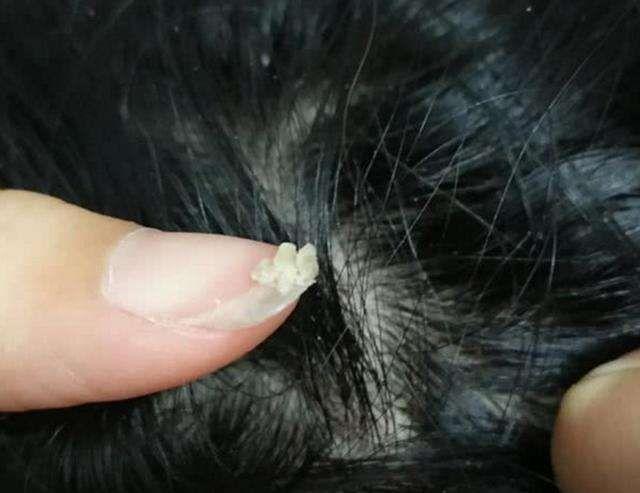 并且用手一挠头皮,指甲缝中全是白泥,头皮上还有红色小疙瘩,这种头皮