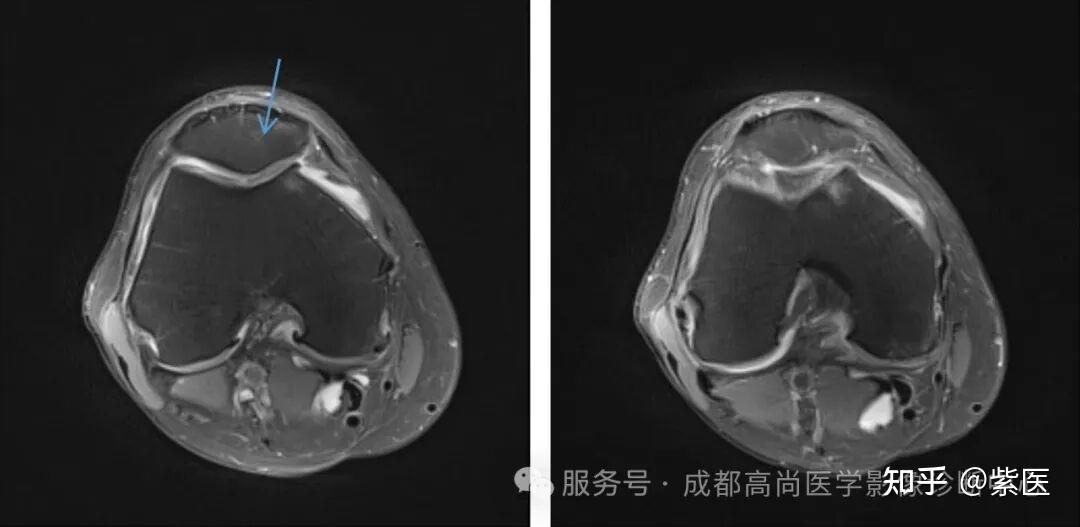 膝关节滑膜皱襞综合征(MPS)MR诊断 - 知乎