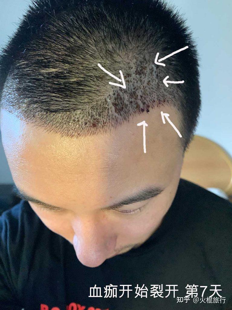 30岁男人植发(男人植发有什么危害)