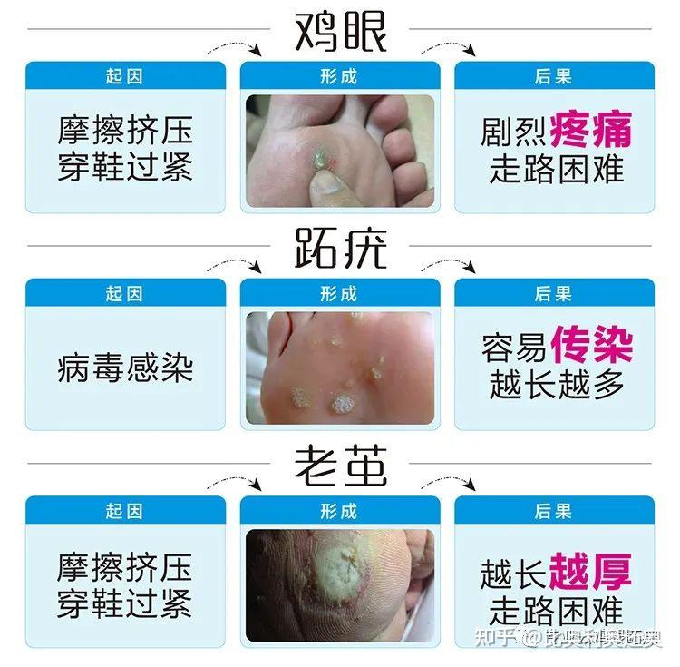 如何来辨别是跖疣还是鸡眼呢?