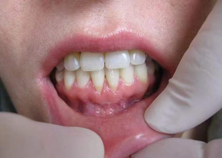 牙宣怎么快速消肿图片