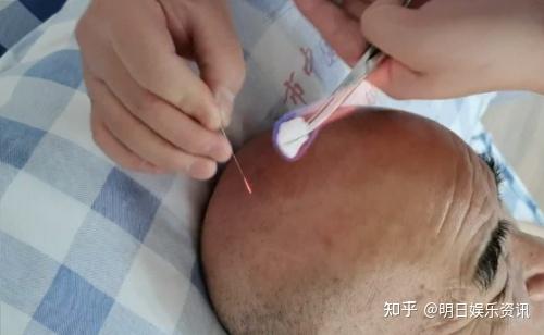 粟龙教授针到病除让脑卒中脑梗中风后遗症重现希望