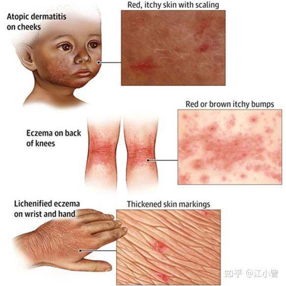 皮肤又干又痒？你有可能是特应性皮炎 - 知乎