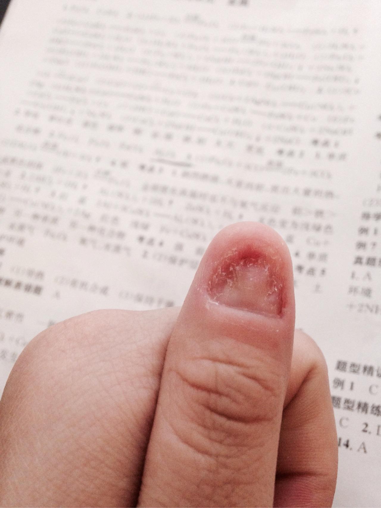 拔指甲是什么样的体验?很疼么?