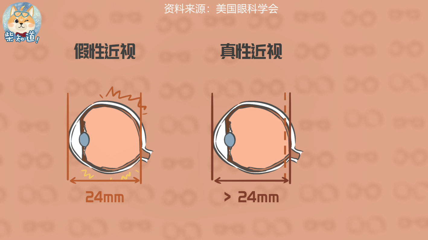 此时的眼睛在休息一段时间后,还能恢复过来,因此这种近视也叫假性近视