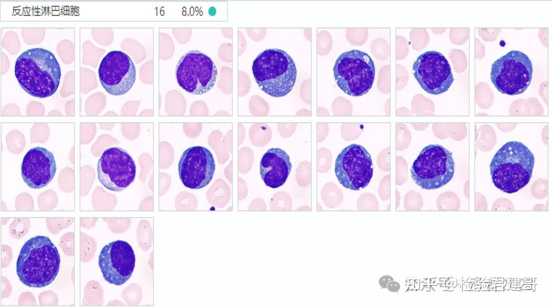 【高清大图】看懂反应性淋巴细胞（异型淋巴细胞），这篇就够了！ - 知乎