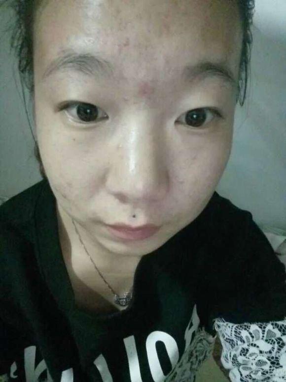 额头上好多小粉刺 脸上痘痘怎么办 ? - 知乎