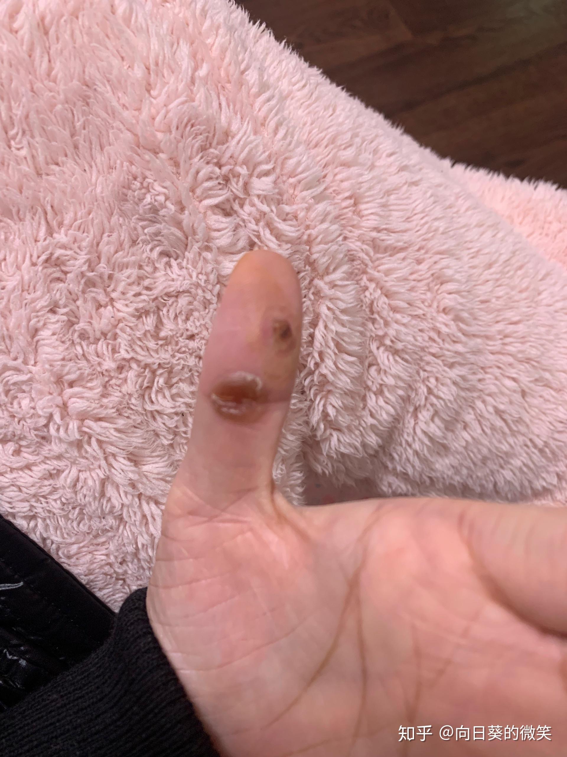 90后二胎宝妈,怀孕后 左手大拇指长的肉芽肿