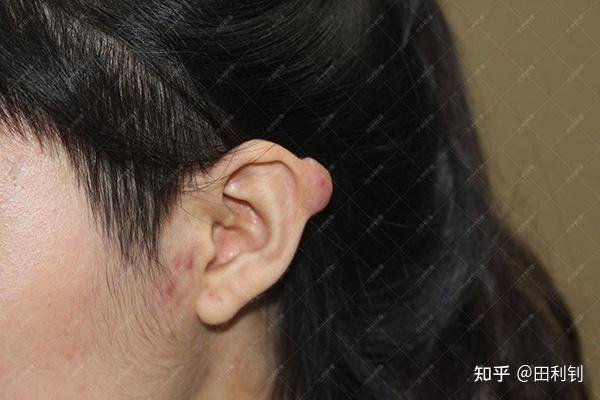 山西22岁赵女士耳朵疤痕疙瘩治疗案例