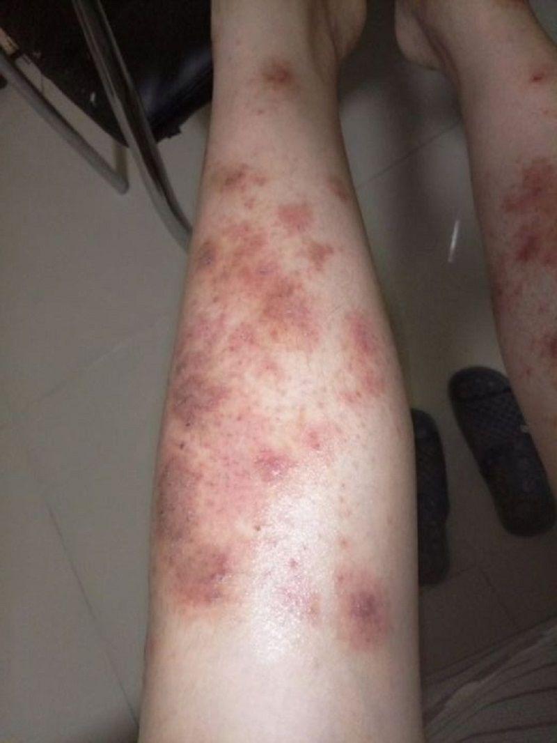 慢性湿疹用什么药有什么去湿疹的好办法吗