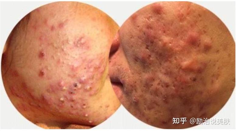 痘痘又称为"面部痤疮",虽然说一般常见于青少年,但是现在它却成为多少