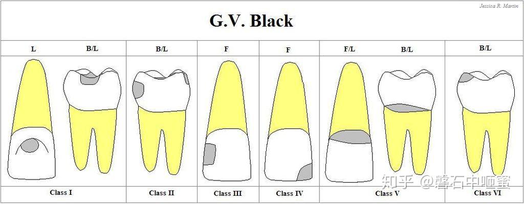 牙齿修复dentalrestoration