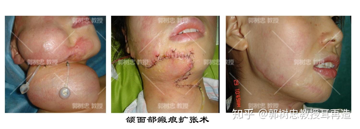 扩张器是治疗疤痕最好的利器