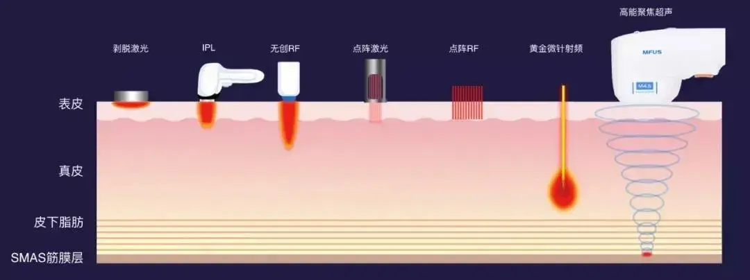 那什么是smas筋膜层呢?