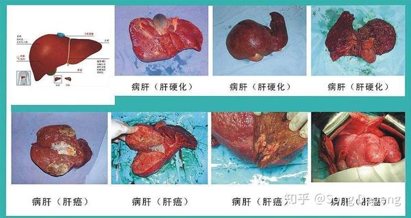 漫谈乙肝:乙肝病毒与乙肝患者