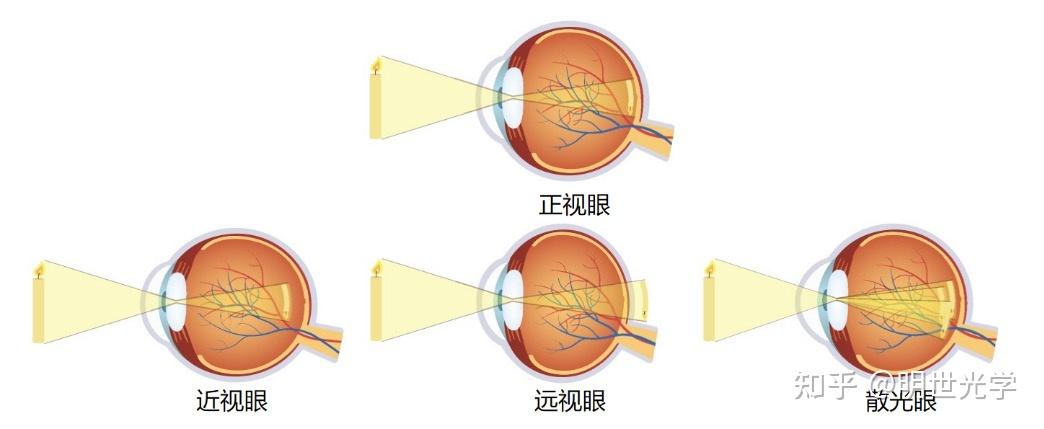 文献分享:《减少旁中心远视离焦镜片的前世今生》 - 知乎
