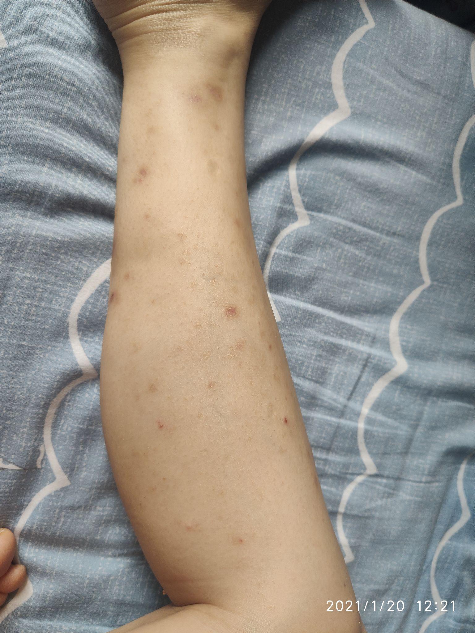 特应性皮炎/湿疹/蚊子疤痕(修复全过程) - 知乎